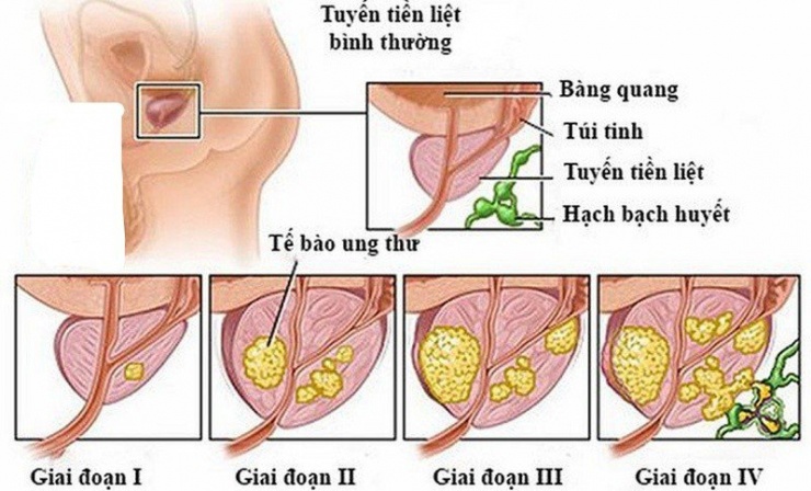 Các giai đoạn của ung thư tuyến tiền liệt. Ảnh: Bệnh viện K