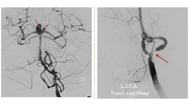 Bệnh nhân vừa bị hẹp mạch máu (hình bên phải) dẫn tới nhồi máu não vừa bị phình mạch máu (hình bên trái) nguy cơ xuất huyết não
