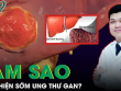 Làm sao để phát hiện sớm ung thư gan?