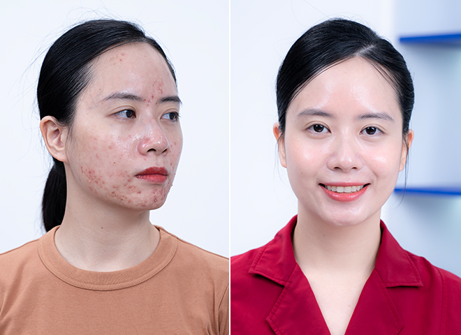         Hình ảnh khách hàng trước và sau khi điều trị bằng công nghệ Meso Extra không kim