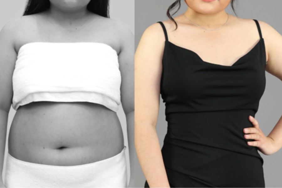 4 nhóm thực phẩm “vàng“ giúp làm sáng da, ngăn ngừa lão hóa 4 Hình ảnh trước và sau khi giảm mỡ công nghệ Lipo Hifu tại TMV Ngọc Dung