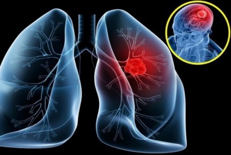 Bác sĩ viện K tư vấn cách phòng tránh ung thư phổi