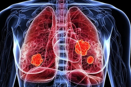 Cô gái 29 tuổi bất ngờ nhận kết quả ung thư phổi sau 1 tuần ho khan