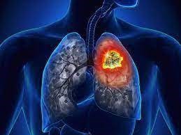 Đáng sợ hơn cả thuốc lá, đây là 2 nguyên nhân khiến ung thư phổi tìm đến cực nhanh - 1