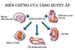 Người phụ nữ 35 tuổi ở Hà Nội bị suy thận, cao huyết áp thừa nhận một sai lầm nhiều người Việt mắc phải