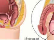 Bé trai 11 tuổi đã mắc ung thư tinh hoàn, chuyên gia cảnh báo dấu hiệu phát hiện sớm bệnh