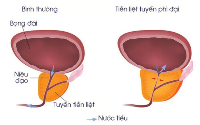 Phì đại tuyến tiền liệt có thể gây rối loạn chức năng tình dục.