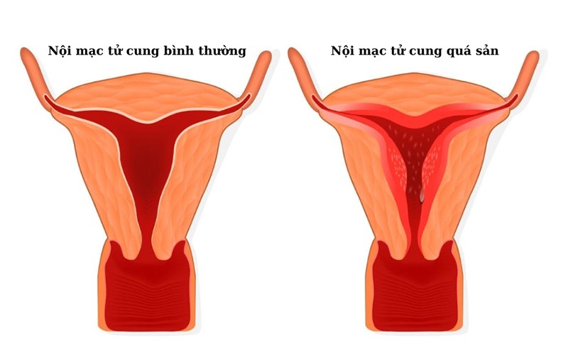 Tăng sinh nội mạc tử cung là tình trạng niêm mạc tử cung dày lên quá mức, có thể tiến triển thành ung thư