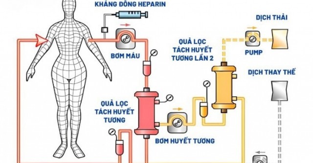 Lọc Huyết Tương Bằng Hai Quả Lọc: Công Nghệ Mới Cho Sức Khỏe