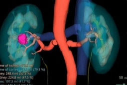 Phát hiện ung thư thận dù không triệu chứng