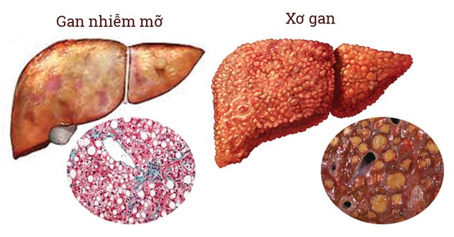 Ga nhiễm mỡ nếu không được điều trị có thể gây xơ gan, ung thư gan. Ảnh minh họa