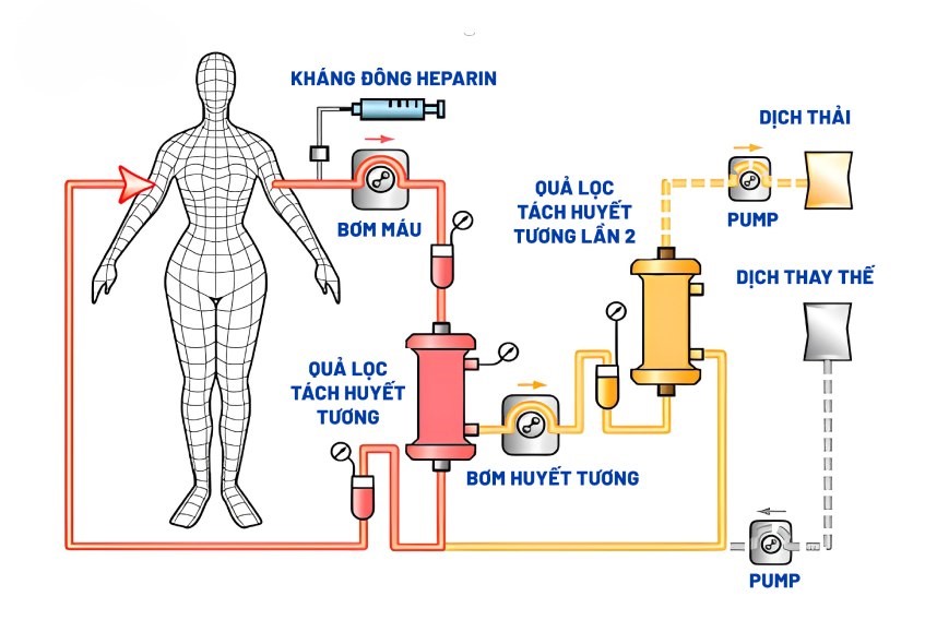 Nguyên lý thực hiện của phương pháp Lọc máu DFPP