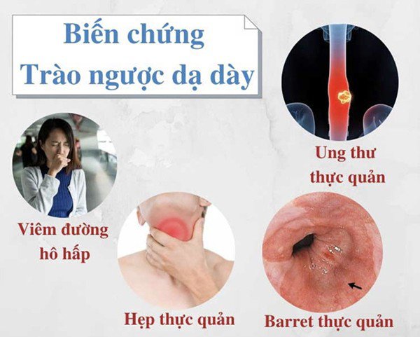 Trào ngược dạ dày thực quản có thể gây ra những biến chứng nguy hiểm nếu không điều trị sớm