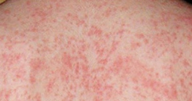 Hà Nội: Hơn 100 trường hợp mắc sởi trong tuần, khuyến cáo cách bảo vệ con trong những ngày thời tiết nồm ẩm