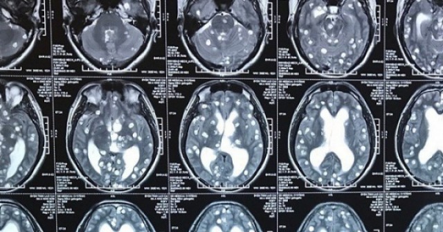 Rối loạn tâm thần do sán làm tổ trong não