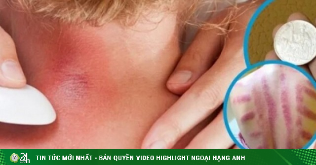 Vì sao đau mỏi người, 'trúng gió' dùng đồ bạc, trứng gà để cạo gió?