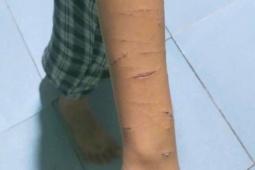 Chỉ đạo xử lý vụ học sinh lớp 5 bị chị họ dùng dao rạch nhiều lần tại Cà Mau