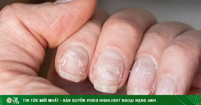 'Kiếp nạn' tháo nails giả sau Tết và những điều cần lưu ý để bớt hại móng