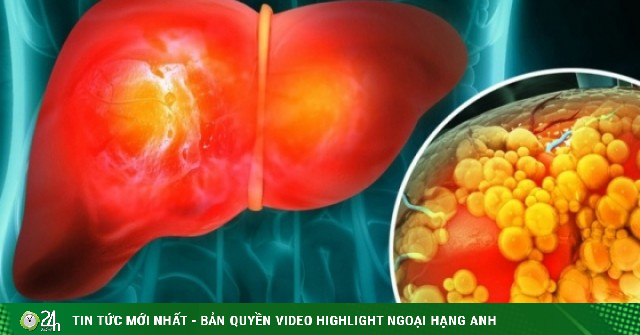 Một thói quen ăn uống quen thuộc có thể làm tăng nguy cơ ung thư gan, người Việt nên tránh