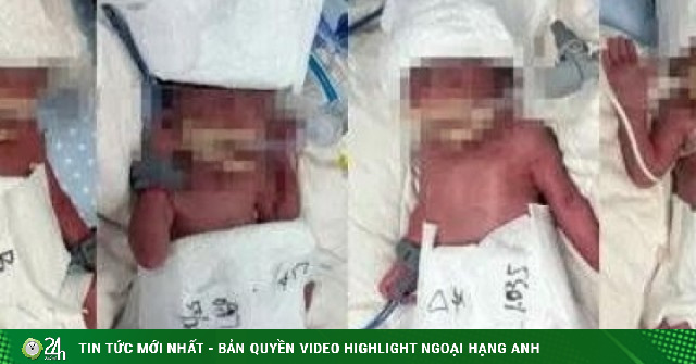 Sản phụ 24 tuổi sinh 5 con sau thụ thai tự nhiên