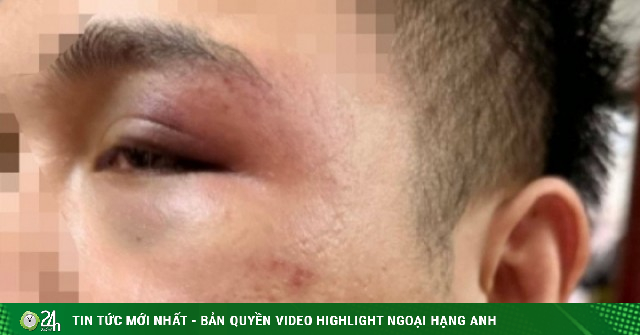 Hà Nội: Từ chối chở khách say xỉn, tài xế xe công nghệ bị đánh sưng mặt