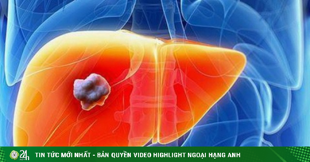 Người đàn ông 44 tuổi phát hiện ung thư gan sau khi xét nghiệm men gan tăng cao: Có 1 thói quen nhiều người Việt mắc phải