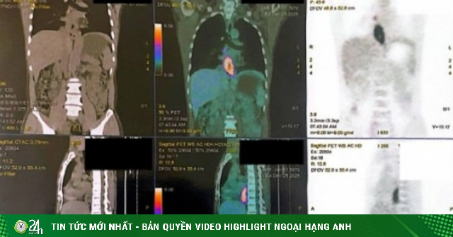Nuốt nghẹn, sụt 5 kg, đi khám phát hiện mắc hai loại ung thư