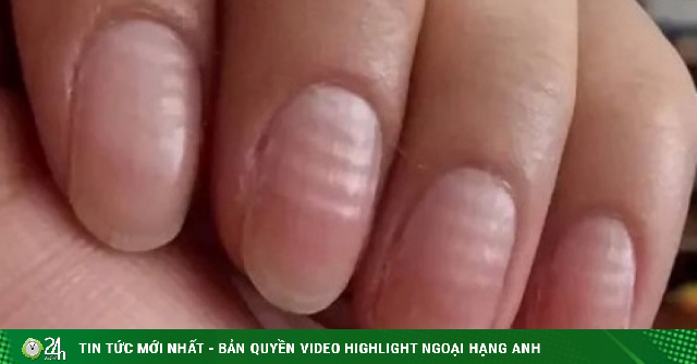 5 dấu hiệu trên móng tay cảnh báo vấn đề sức khỏe nghiêm trọng lại hay bị ngó lơ