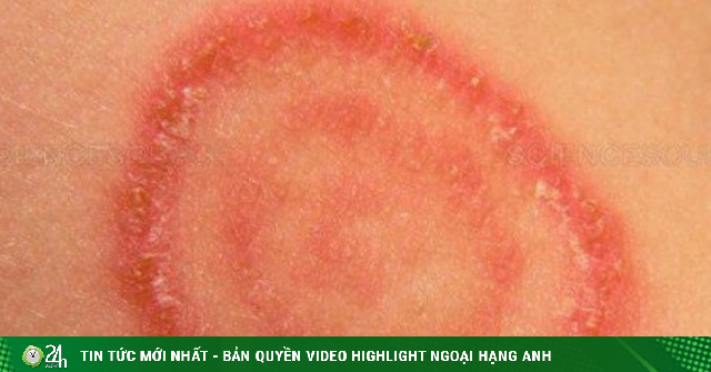 Cảnh giác nấm da lây từ chó, mèo