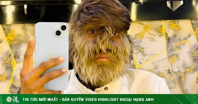 Cuộc sống của thiếu niên có nhiều lông nhất thế giới giờ ra sao?