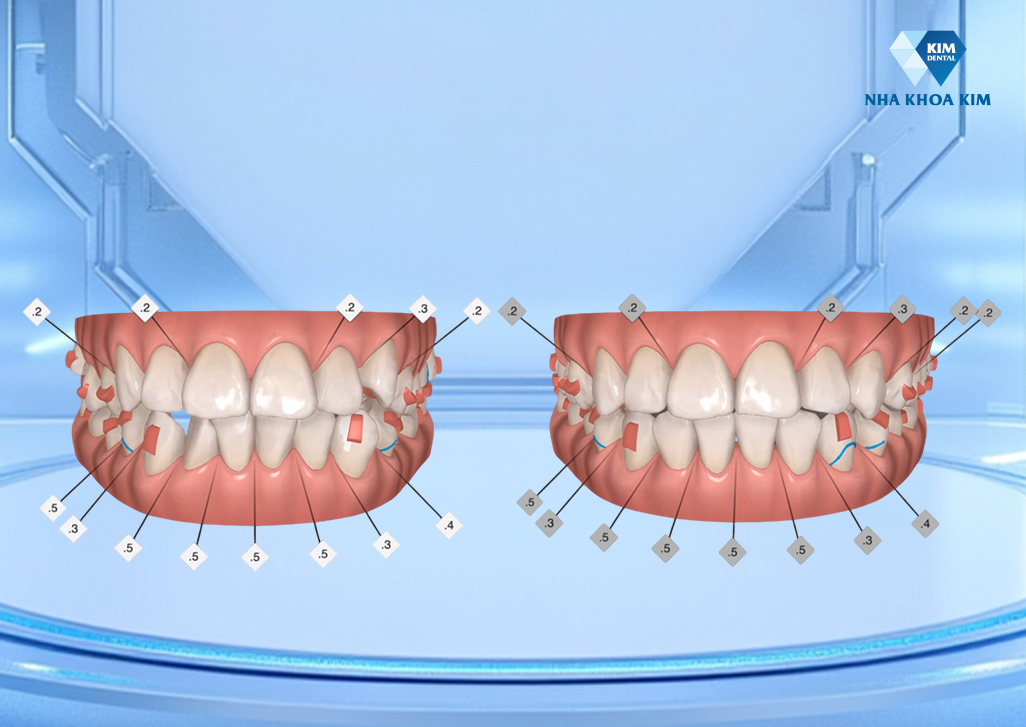 Công nghệ AI mô phỏng giúp nhìn thấy trước kết quả sau khi niềng răng tại Nha Khoa Kim