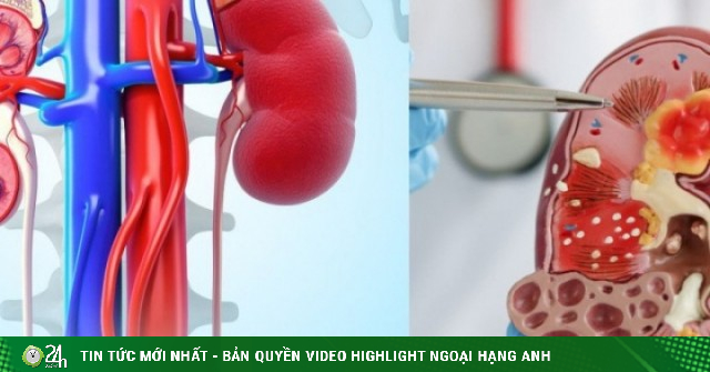 7 loại trái cây quen thuộc người bệnh suy thận nên hạn chế, nhiều người Việt vẫn ăn mỗi ngày