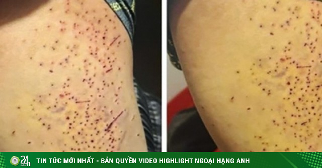 Tranh chấp chỗ ngồi, nữ sinh lớp 7 dùng bút bi đâm nhiều lần vào đùi bạn học