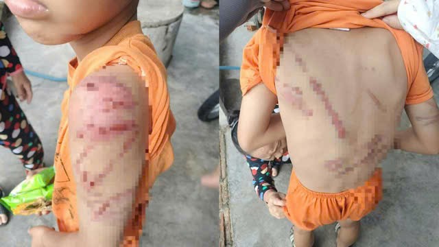 Hình ảnh em học sinh bị cha đánh bầm tím đăng tải trên mạng xã hội gây xôn xao cộng đồng mạng