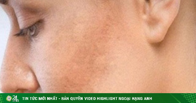Vì sao da ngày càng sạm màu? Cách lấy lại làn da sáng khỏe