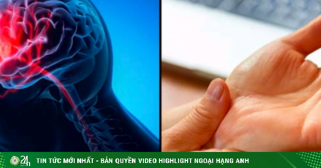 Dấu hiệu nguy hiểm nhất của đột quỵ không phải tê tay chân, nhiều người vẫn đang hiểu lầm