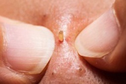 Tin tức sức khỏe - Đàn ông con trai bị mụn: Chấm dung dịch này mỗi tối là sạch, không cần đi Spa với bôi kem như con gái