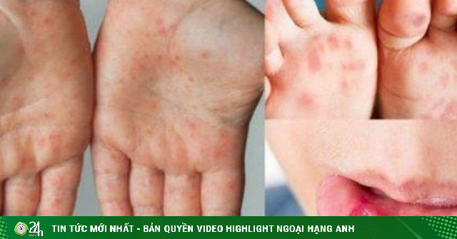 Bệnh tay chân miệng tăng nhanh, xuất hiện chủng nguy hiểm: Cha mẹ cần làm gì để bảo vệ trẻ?
