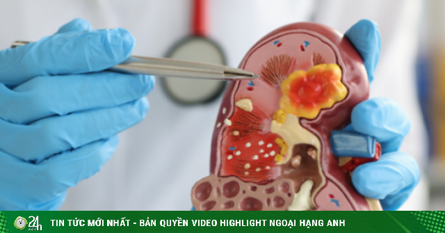 Loại rau ngon bổ nhưng tăng gánh nặng cho thận, người bệnh suy thận cần biết để tránh