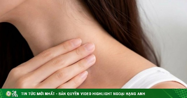 Đi khám u cổ, cô gái sốc phát hiện mắc ung thư dạ dày di căn