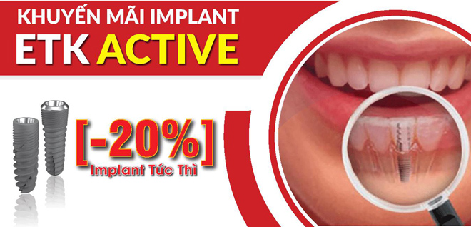 Ưu đãi 20% trồng răng Implant cho khách hàng đăng ký sớm - 1