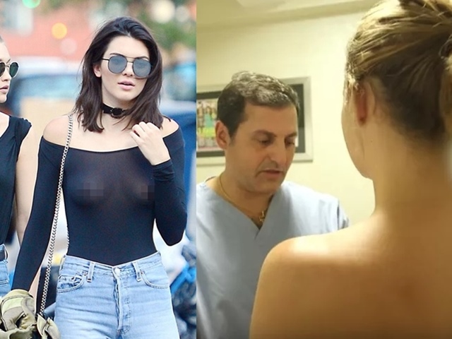 Đổ xô thẩm mỹ “nhũ hoa” để tự tin như Kendall Jenner