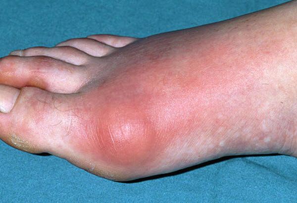 2 sai lầm khiến bệnh gout ngày càng nặng hơn - 2