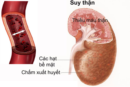 Bệnh thận ảnh hưởng tới tình dục thế nào? - 1