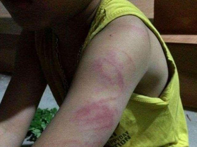 Học sinh lớp 1 bị cô giáo đánh tím tay vì đọc viết chưa thạo