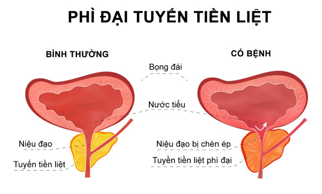 Rối loạn tiểu tiện thường gặp ở nam giới trung niên: Bị gì - Trị sao? - 1