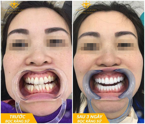 Phục Hình Răng Gần Đây - Những Xu Hướng Và Cách Chăm Sóc Để Có Nụ Cười Tươi Tắn