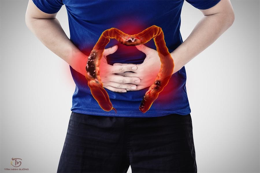 Viêm đại tràng co thắt: Nguyên nhân, triệu chứng và hướng điều trị - 1