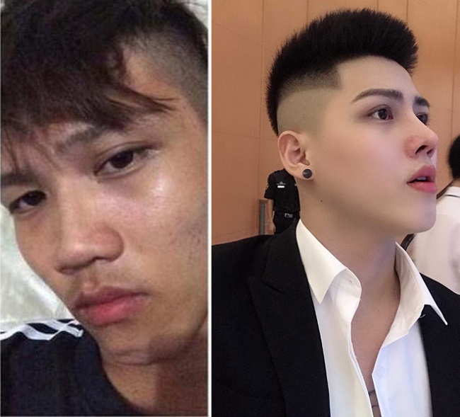 Hơn 1 năm trước, chàng trai sinh năm 1997 có tên Huỳnh Phước Toàn gây bất ngờ khi chia sẻ ảnh trước và sau thẩm mỹ trên mạng xã hội. Anh biến thành hot boy sau quá trình tiêm môi, làm mũi và gọt cằm đau đớn.