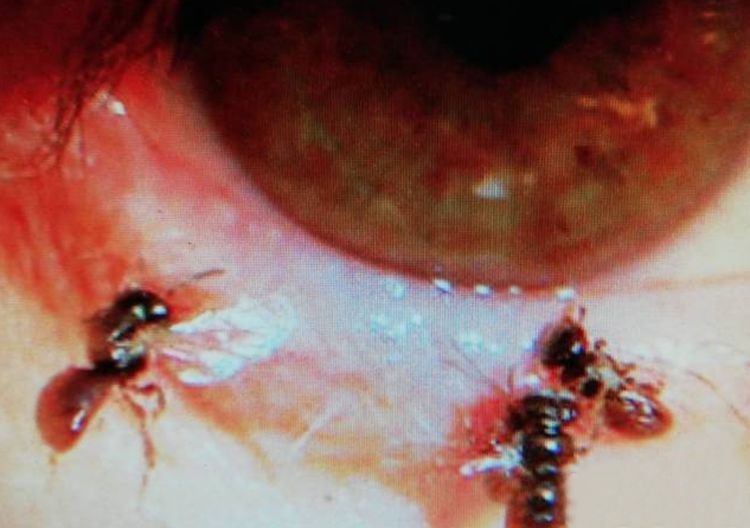 Bác sĩ tìm thấy 4 con ong còn sống trong mắt của người phụ nữ - 1